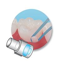 Mini Mold® – Button - Ortomat Herpola